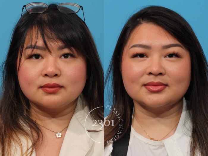Before & After Neck Liposuction Case 892 Front View in Fort Worth, Plano, & Frisco, Texas