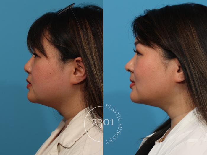 Before & After Neck Liposuction Case 892 Left Side View in Fort Worth, Plano, & Frisco, Texas