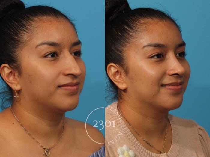 Before & After Rhinoplasty Case 893 Right Oblique View in Fort Worth, Plano, & Frisco, Texas