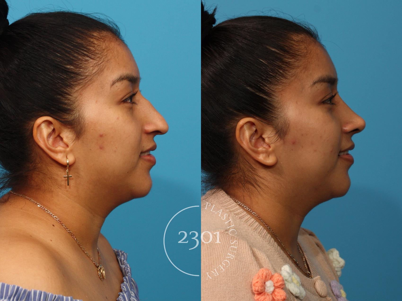 Before & After Rhinoplasty Case 893 Right Side View in Fort Worth, Plano, & Frisco, Texas