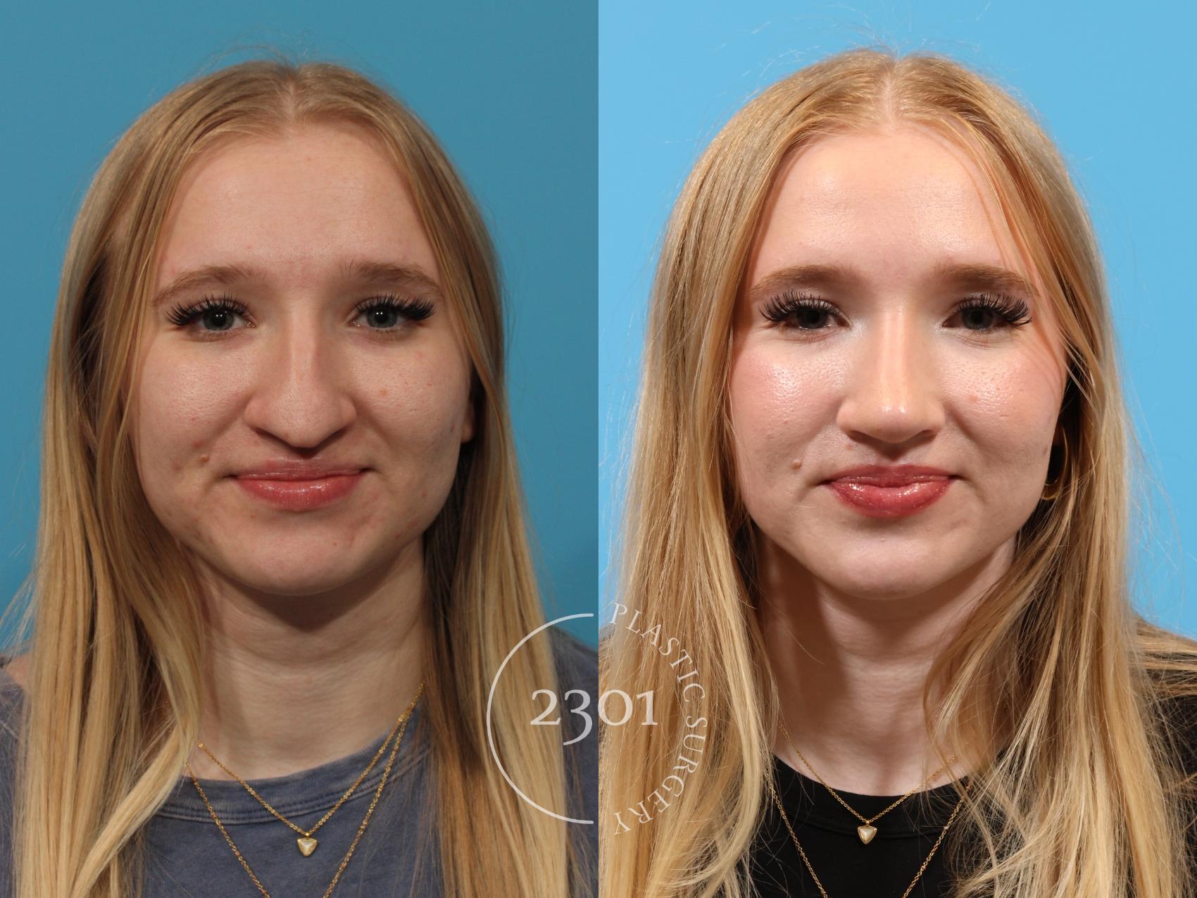 Before & After Rhinoplasty Case 895 Front View in Fort Worth, Plano, & Frisco, Texas