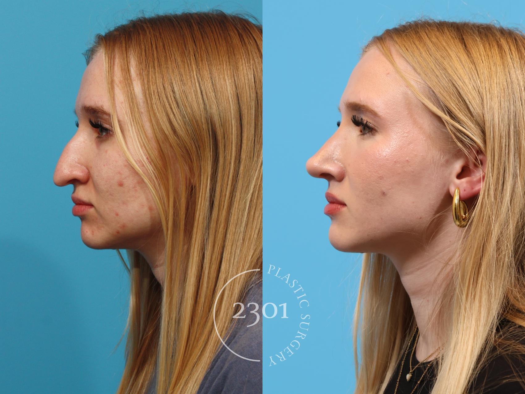 Before & After Rhinoplasty Case 895 Left Oblique View in Fort Worth, Plano, & Frisco, Texas