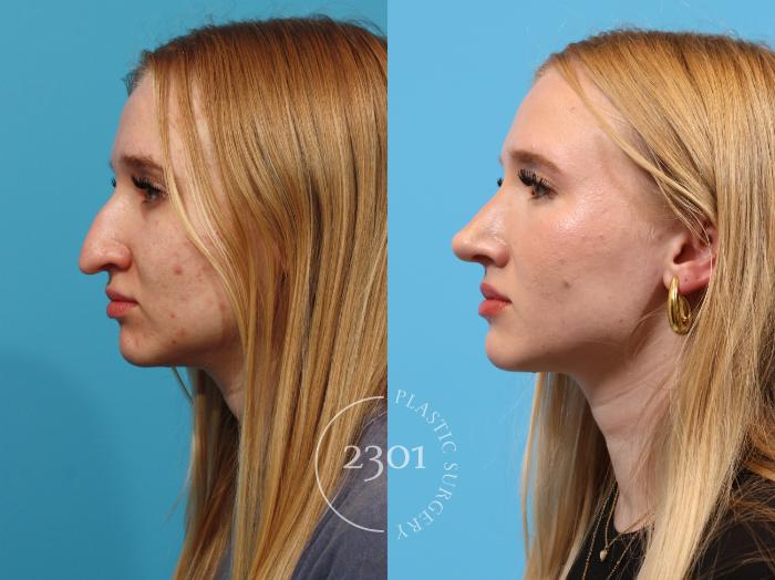 Before & After Rhinoplasty Case 895 Left Oblique View in Fort Worth, Plano, & Frisco, Texas