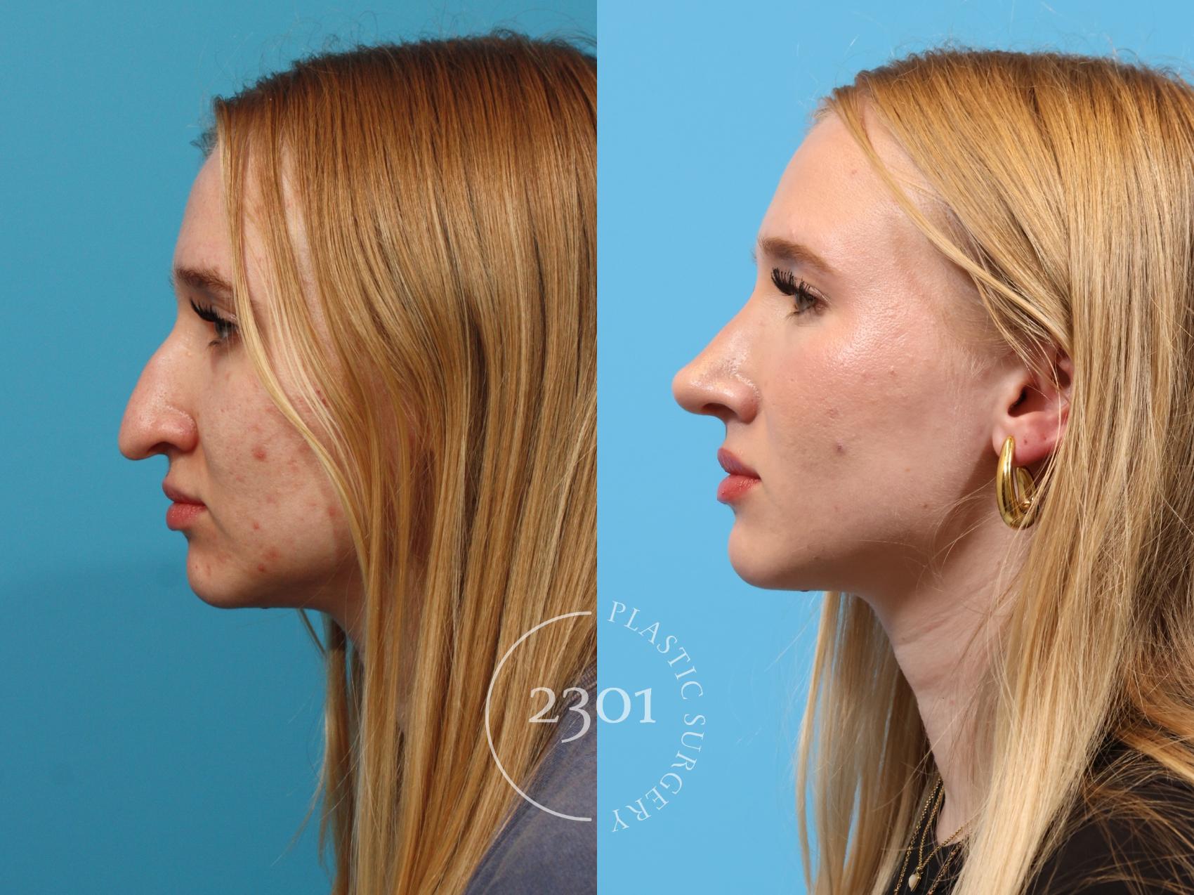 Before & After Rhinoplasty Case 895 Left Side View in Fort Worth, Plano, & Frisco, Texas