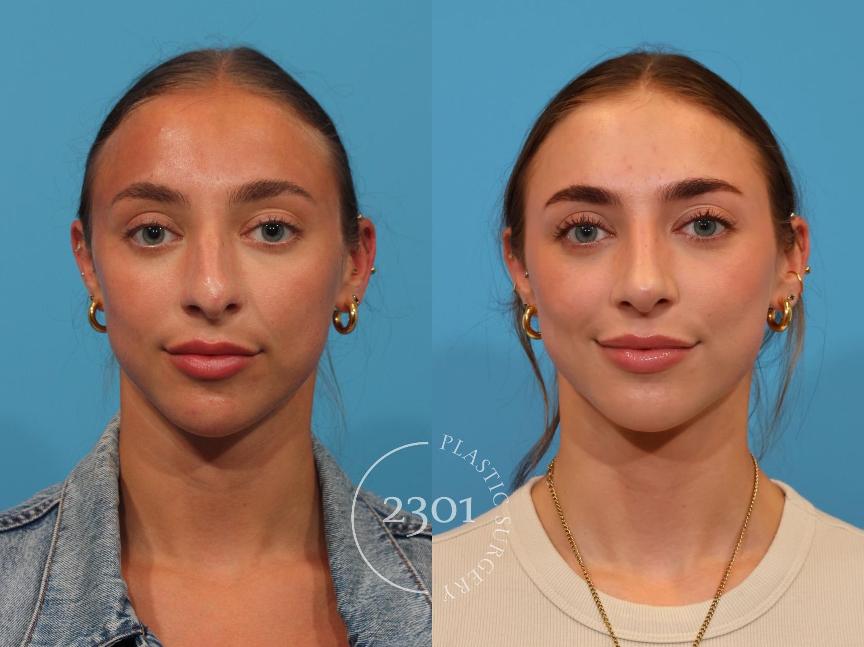 Before & After Rhinoplasty Case 896 Front View in Fort Worth, Plano, & Frisco, Texas