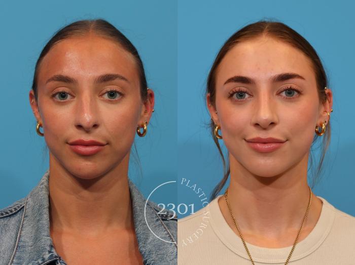 Before & After Rhinoplasty Case 896 Front View in Fort Worth, Plano, & Frisco, Texas
