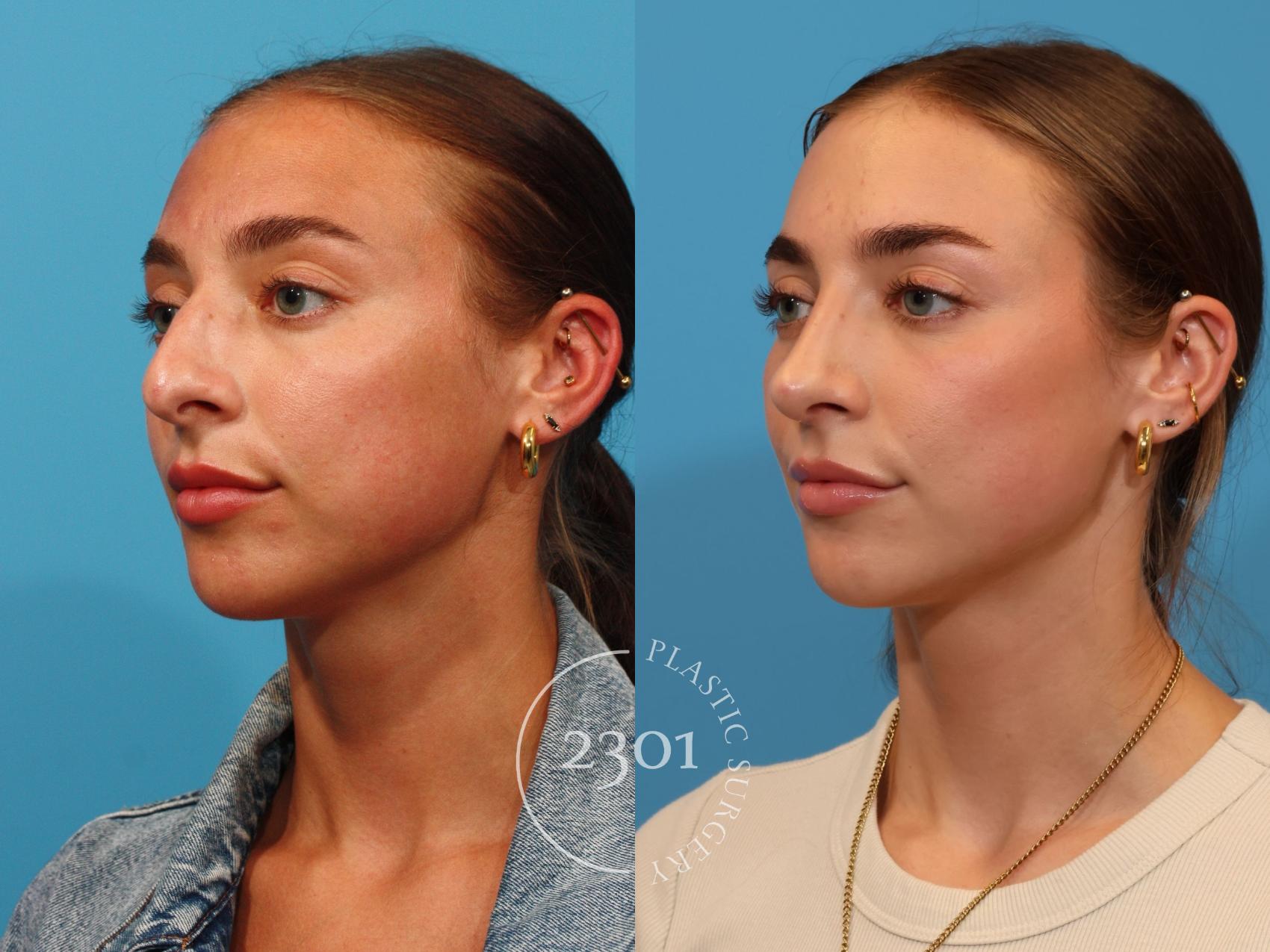 Before & After Rhinoplasty Case 896 Left Oblique View in Fort Worth, Plano, & Frisco, Texas