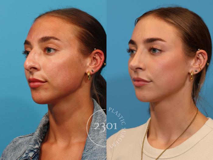 Before & After Rhinoplasty Case 896 Left Oblique View in Fort Worth, Plano, & Frisco, Texas