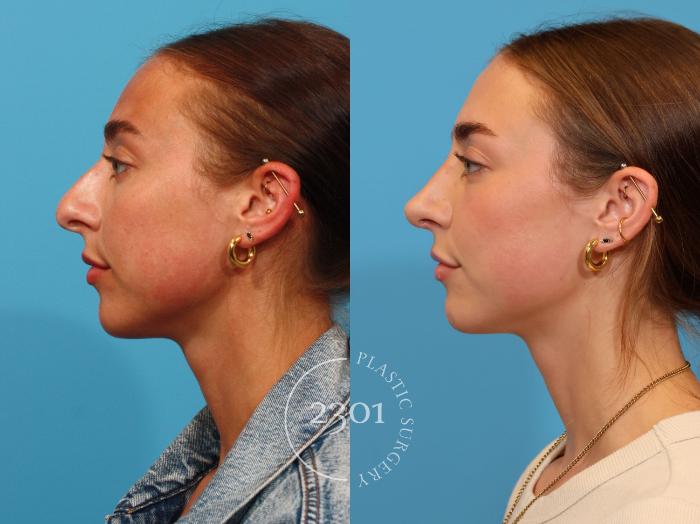 Before & After Rhinoplasty Case 896 Left Side View in Fort Worth, Plano, & Frisco, Texas