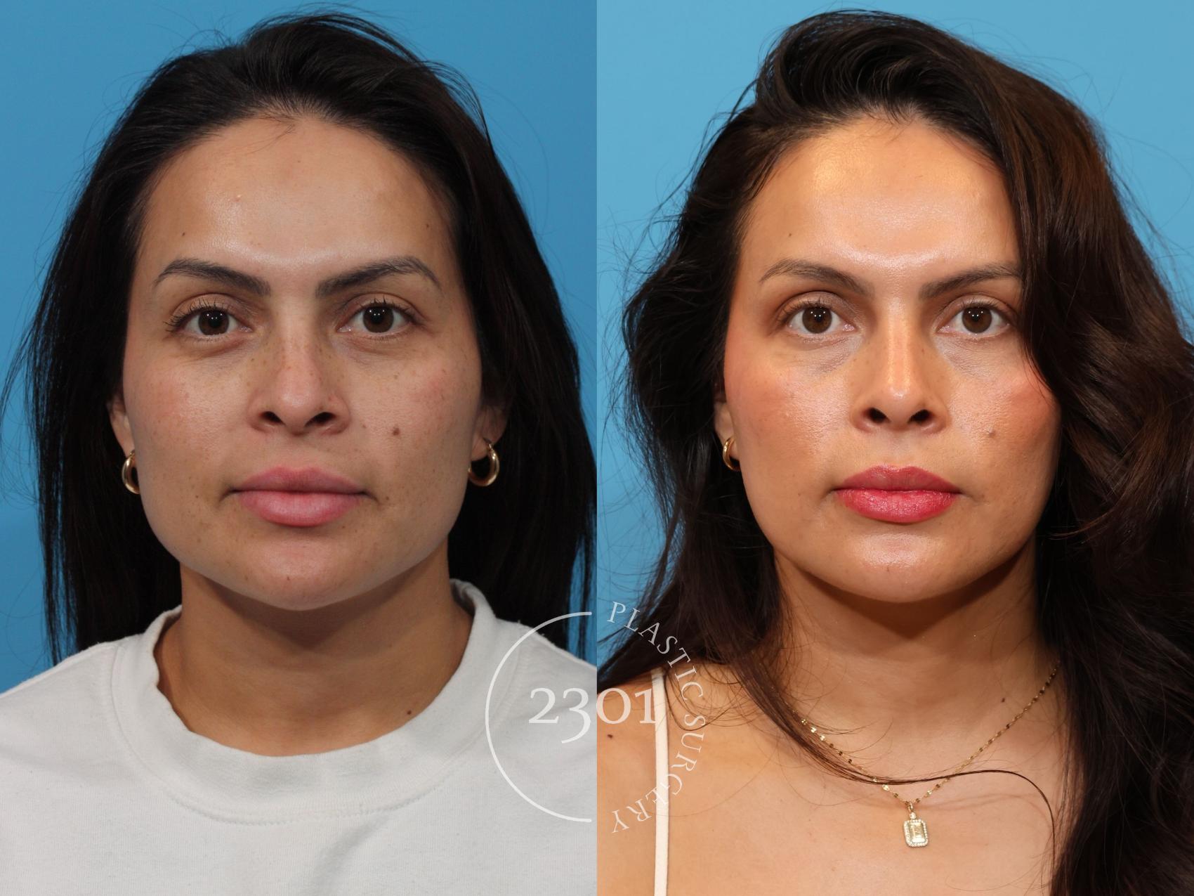 Before & After Rhinoplasty Case 898 Front View in Fort Worth, Plano, & Frisco, Texas