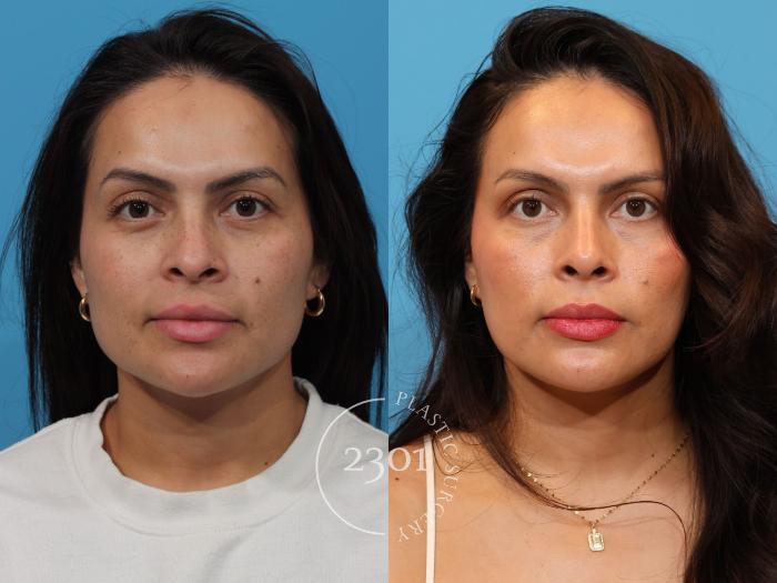 Before & After Rhinoplasty Case 898 Front View in Fort Worth, Plano, & Frisco, Texas