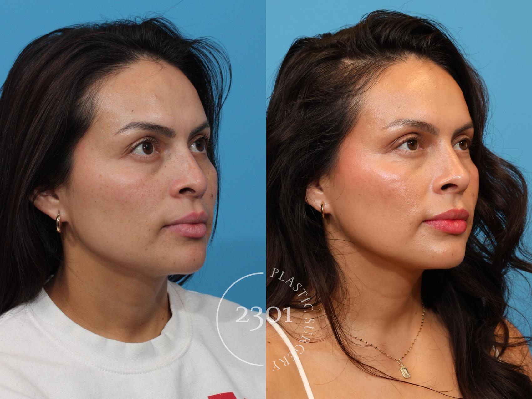Before & After Rhinoplasty Case 898 Right Oblique View in Fort Worth, Plano, & Frisco, Texas