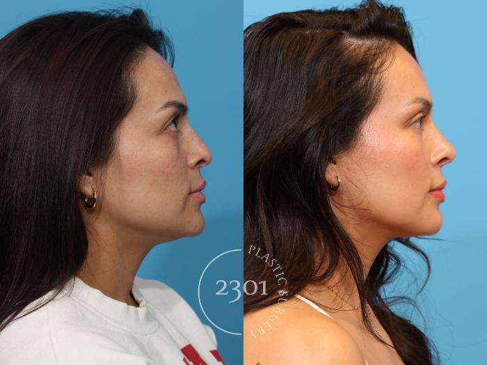 Before & After Rhinoplasty Case 898 Right Side View in Fort Worth, Plano, & Frisco, Texas