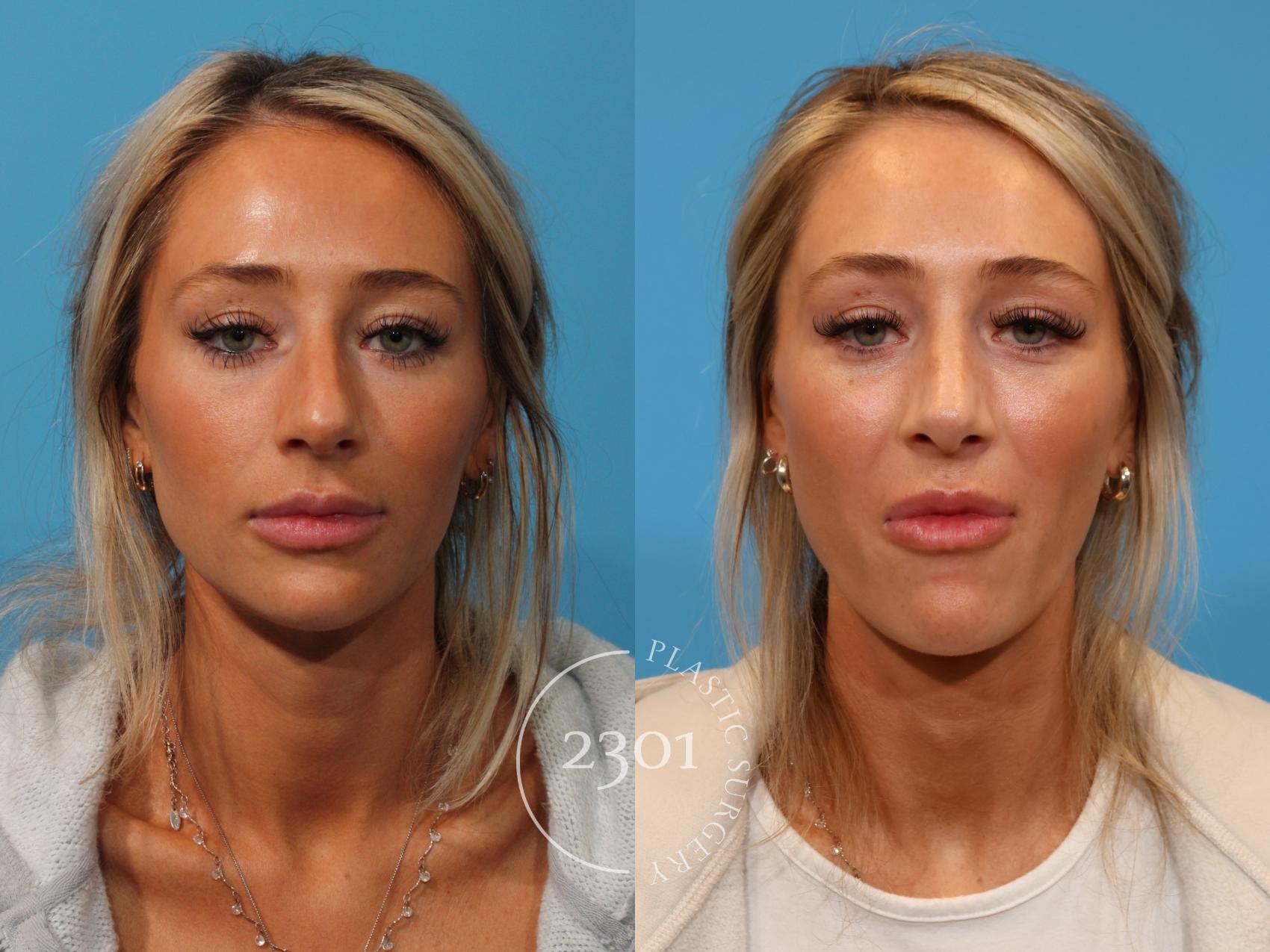 Before & After Rhinoplasty Case 907 Front View in Fort Worth, Plano, & Frisco, Texas