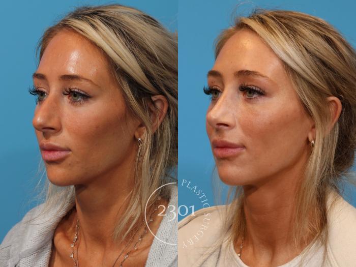 Before & After Rhinoplasty Case 907 Left Oblique View in Fort Worth, Plano, & Frisco, Texas