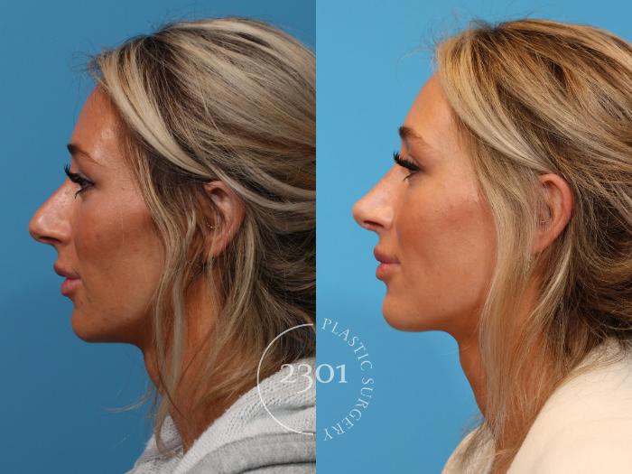 Before & After Rhinoplasty Case 907 Left Side View in Fort Worth, Plano, & Frisco, Texas