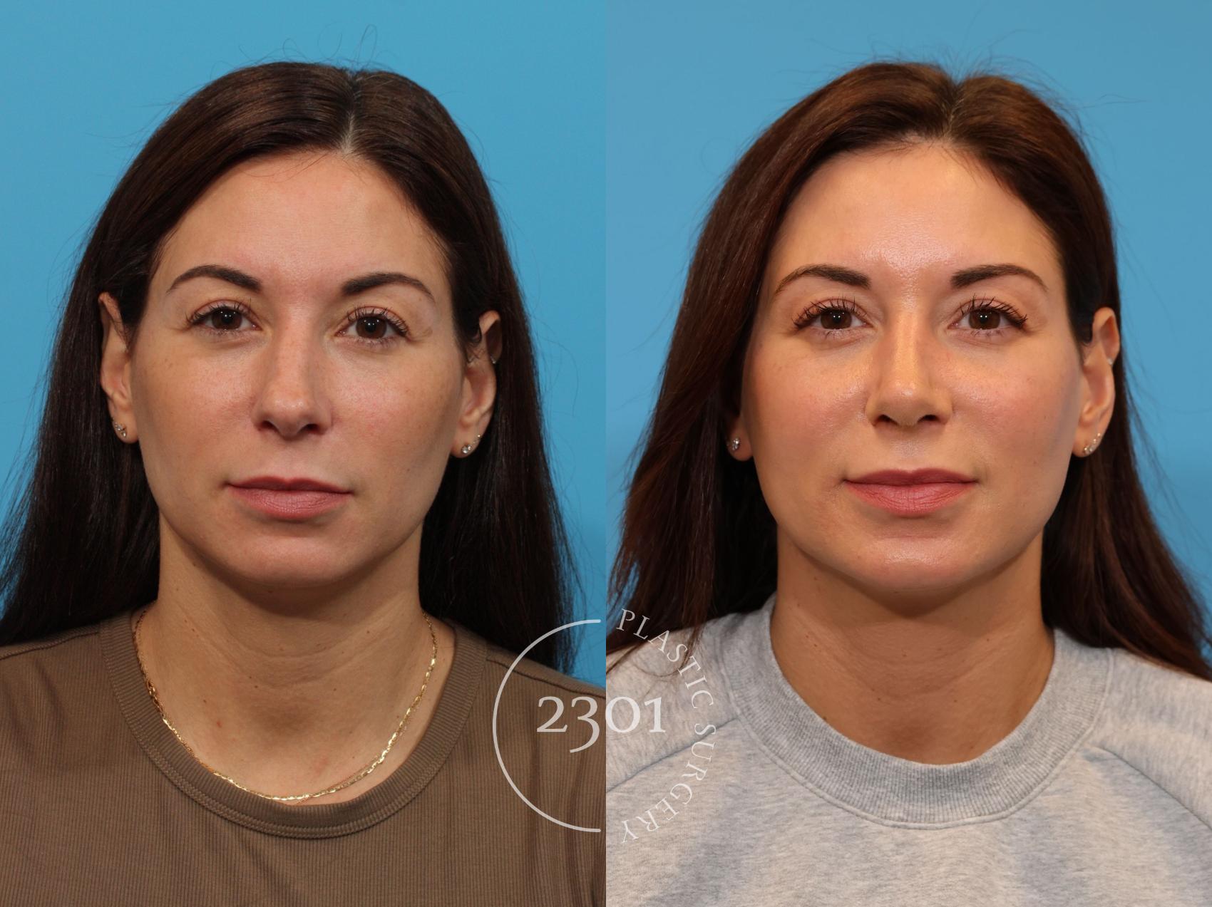 Before & After Rhinoplasty Case 916 Front View in Fort Worth, Plano, & Frisco, Texas