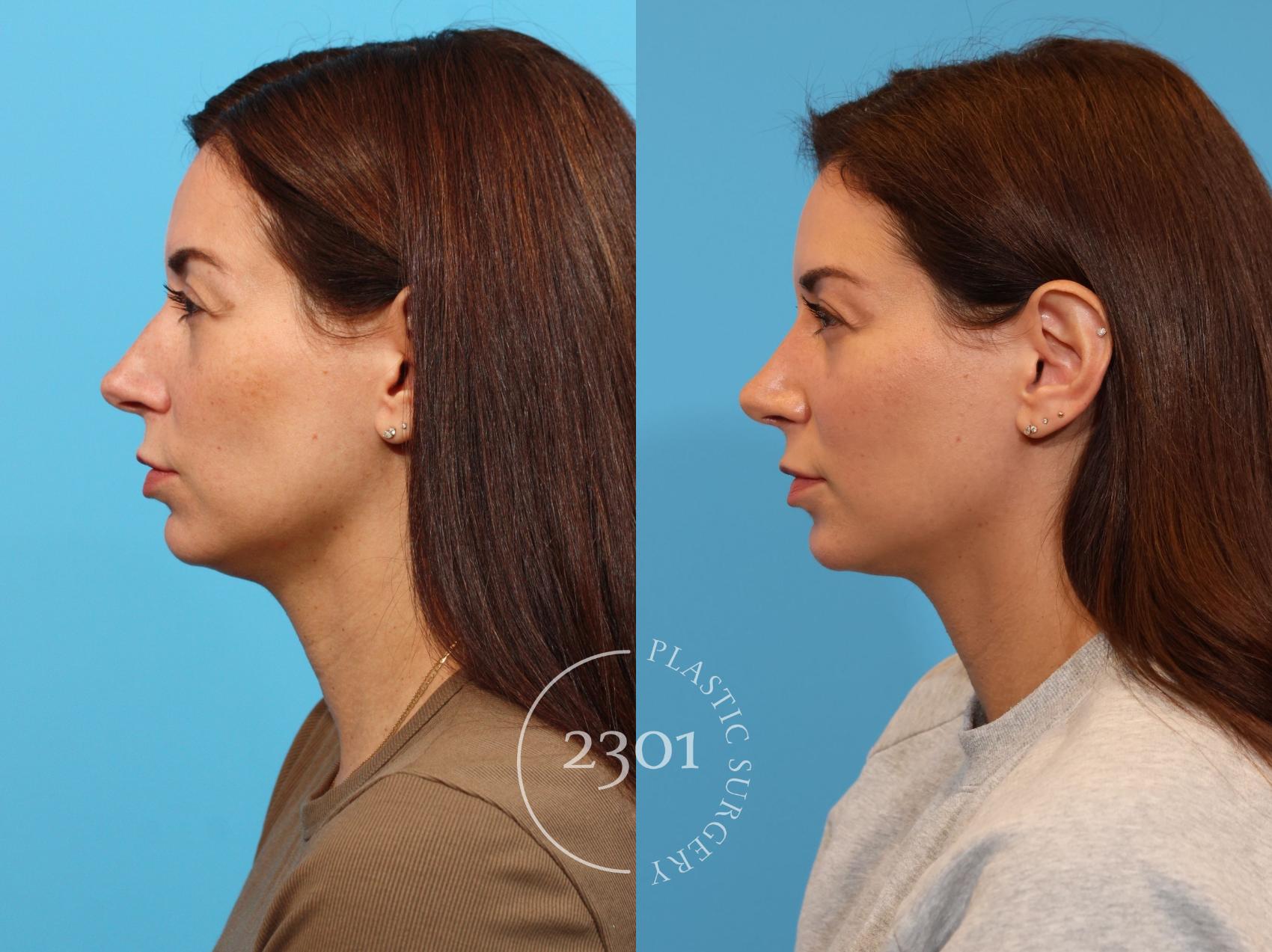 Before & After Rhinoplasty Case 916 Left Side View in Fort Worth, Plano, & Frisco, Texas