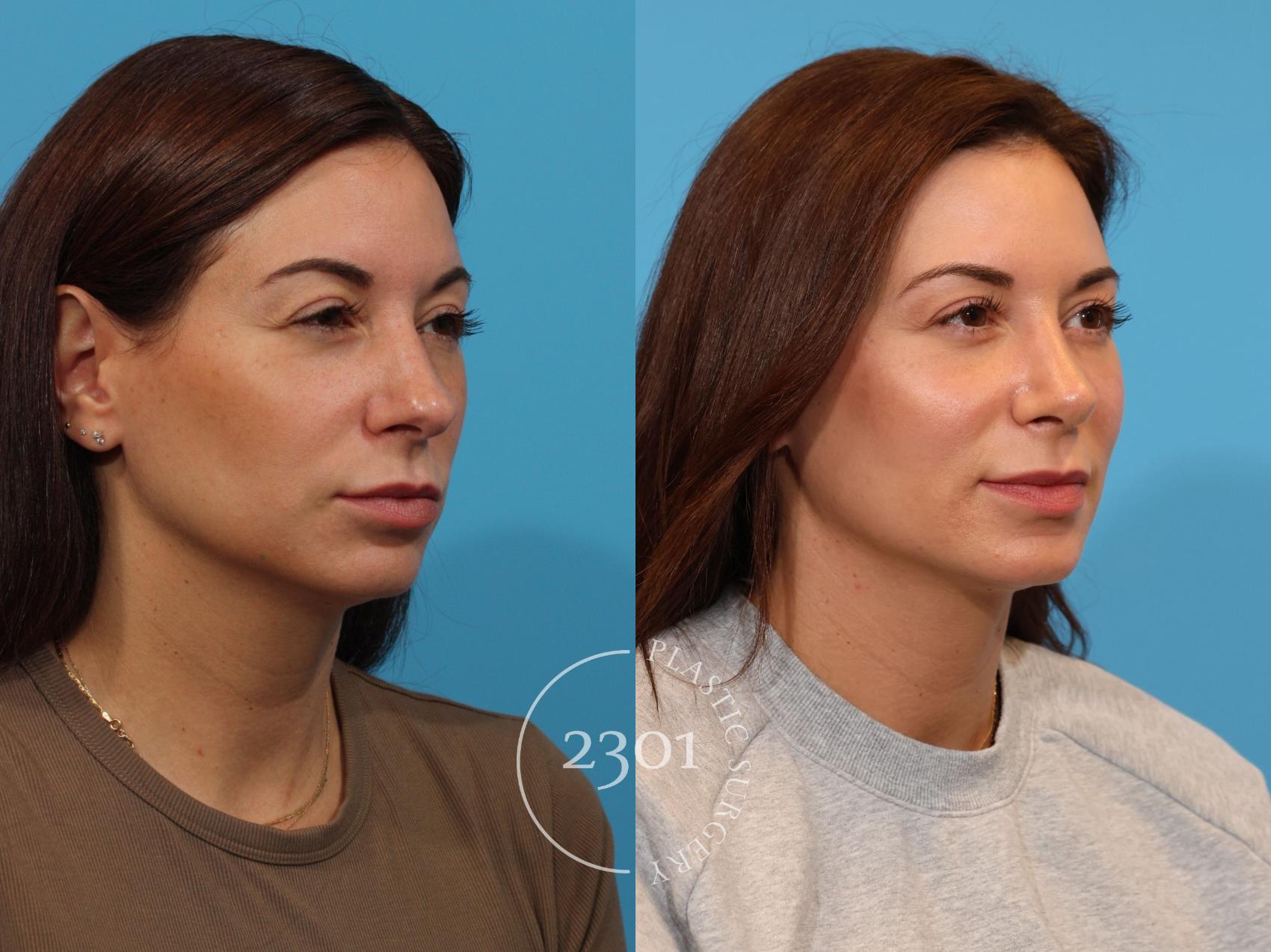 Before & After Rhinoplasty Case 916 Right Oblique View in Fort Worth, Plano, & Frisco, Texas