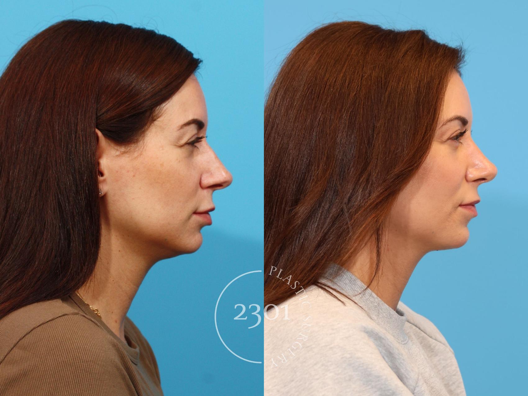 Before & After Rhinoplasty Case 916 Right Side View in Fort Worth, Plano, & Frisco, Texas