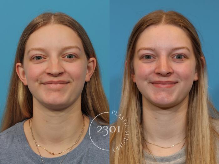 Before & After Rhinoplasty Case 918 Front View in Fort Worth, Plano, & Frisco, Texas