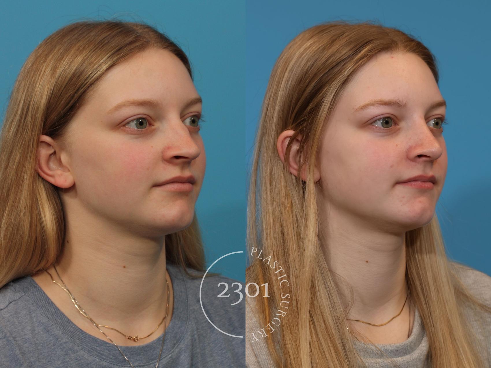 Before & After Rhinoplasty Case 918 Right Oblique View in Fort Worth, Plano, & Frisco, Texas