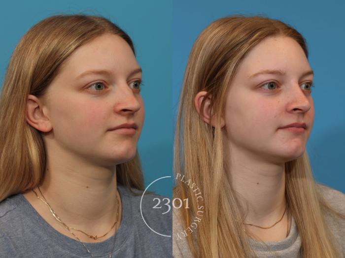 Before & After Rhinoplasty Case 918 Right Oblique View in Fort Worth, Plano, & Frisco, Texas