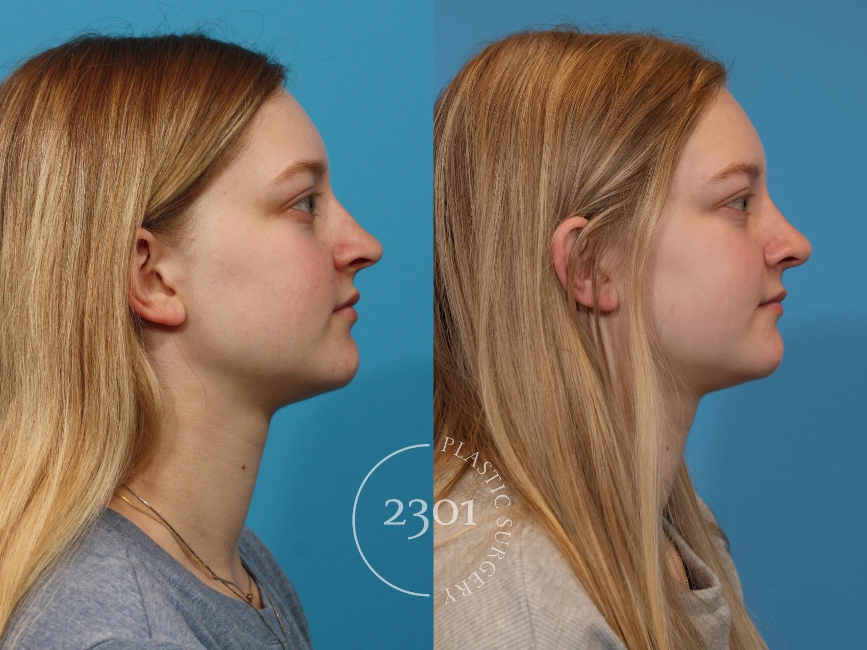 Before & After Rhinoplasty Case 918 Right Side View in Fort Worth, Plano, & Frisco, Texas