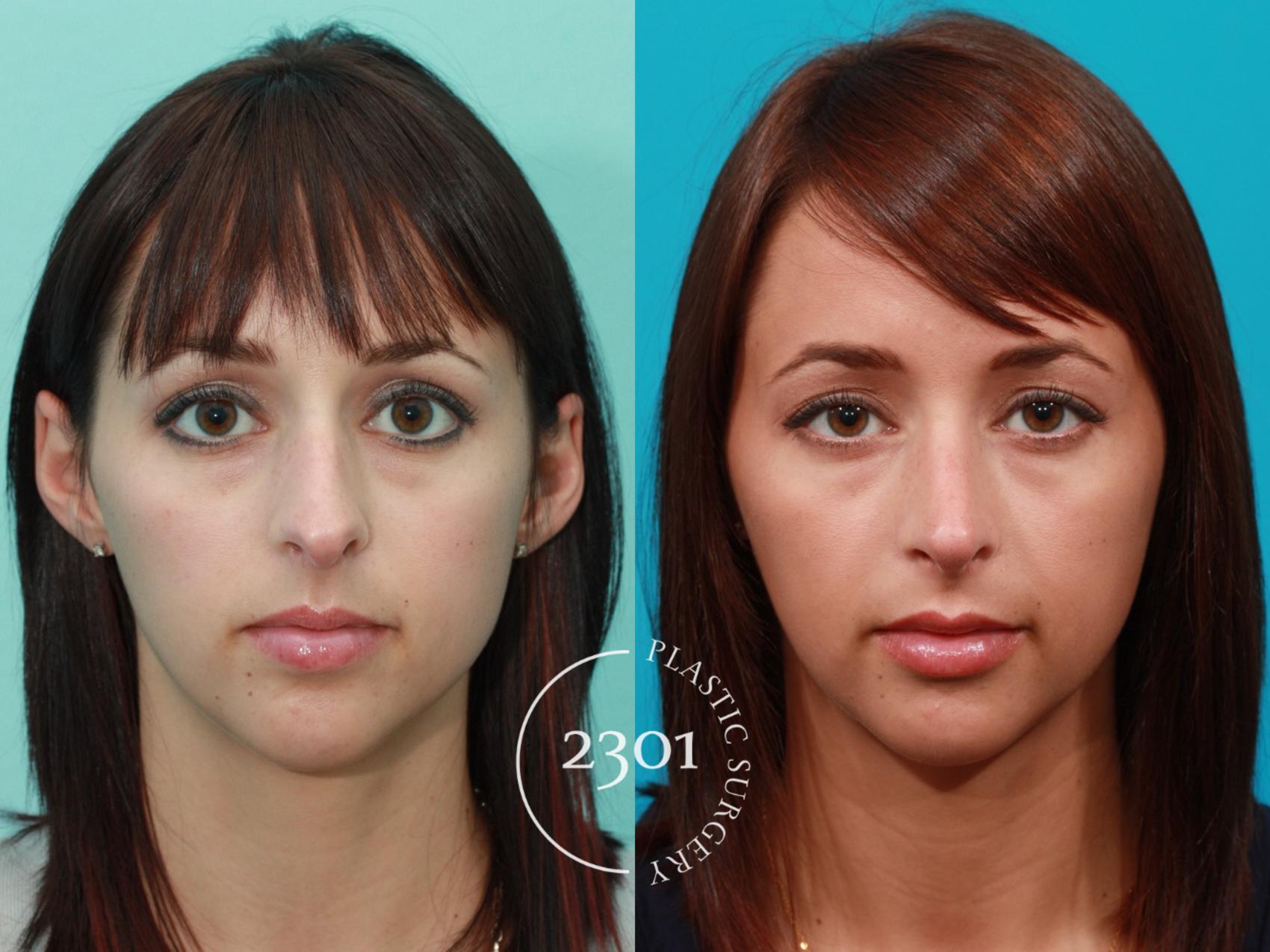 Before & After Rhinoplasty Case 92 View #1 View in Fort Worth, Plano, & Frisco, Texas