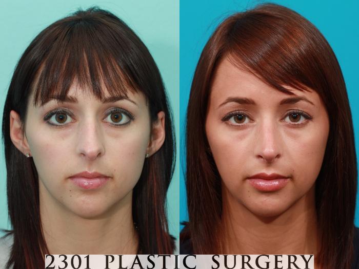 Before & After Rhinoplasty Case 92 View #1 View in Fort Worth, Plano, & Frisco, Texas