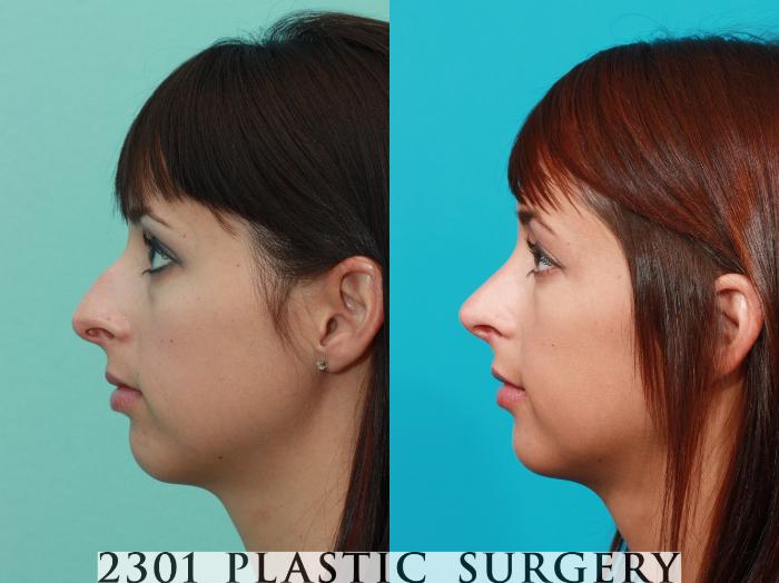 Before & After Rhinoplasty Case 92 View #2 View in Fort Worth, Plano, & Frisco, Texas