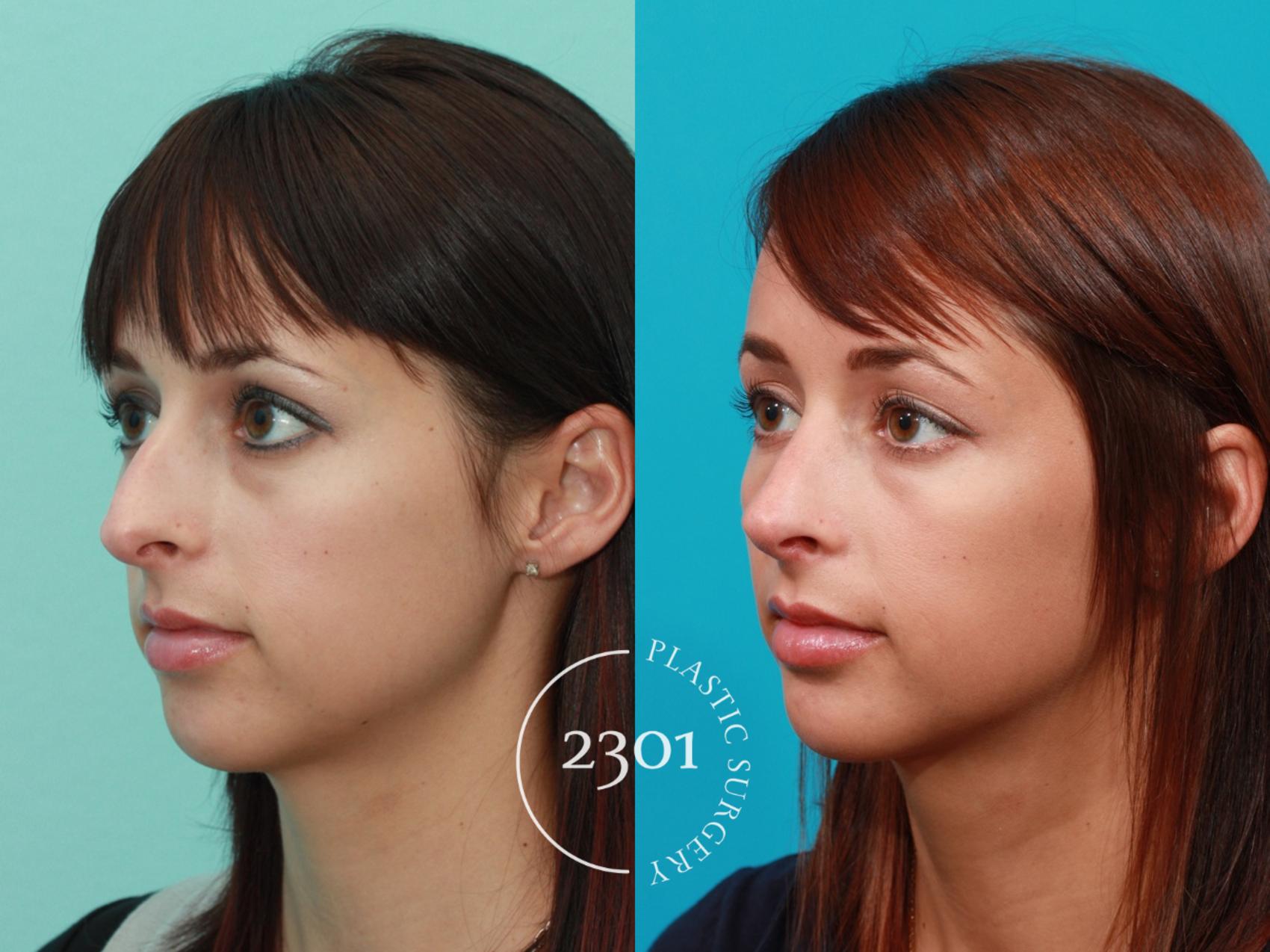 Before & After Rhinoplasty Case 92 View #3 View in Fort Worth, Plano, & Frisco, Texas