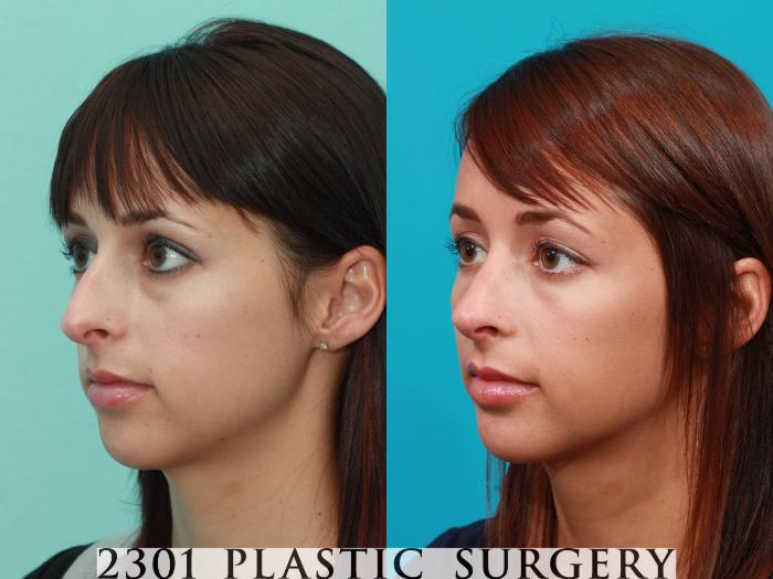 Before & After Rhinoplasty Case 92 View #3 View in Fort Worth, Plano, & Frisco, Texas