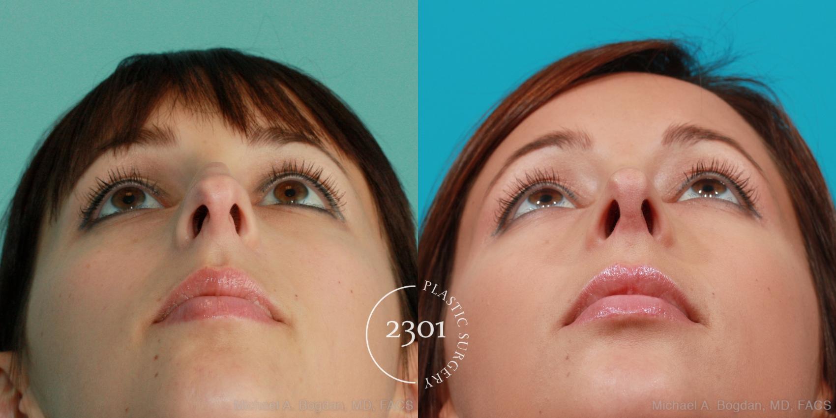 Before & After Rhinoplasty Case 92 View #4 View in Fort Worth, Plano, & Frisco, Texas