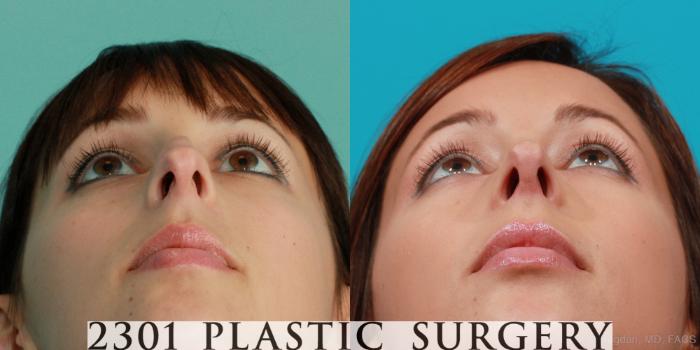 Before & After Rhinoplasty Case 92 View #4 View in Fort Worth, Plano, & Frisco, Texas