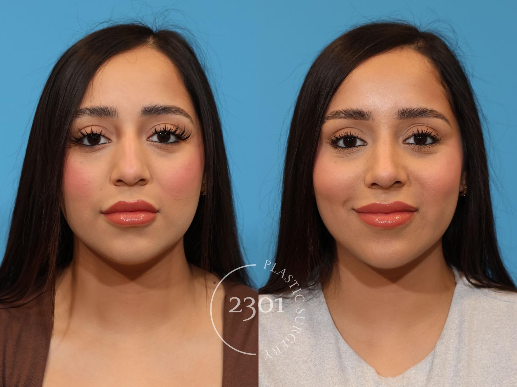 Before & After Rhinoplasty Case 922 Front View in Fort Worth, Plano, & Frisco, Texas