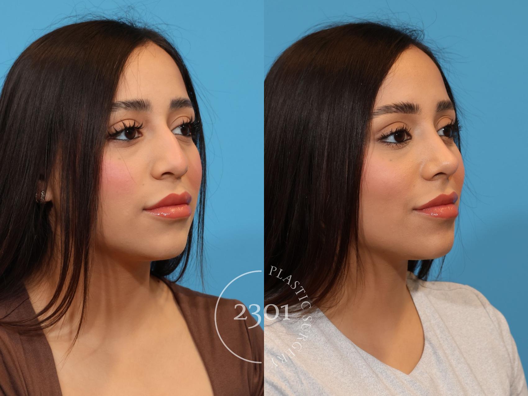 Before & After Rhinoplasty Case 922 Right Oblique View in Fort Worth, Plano, & Frisco, Texas