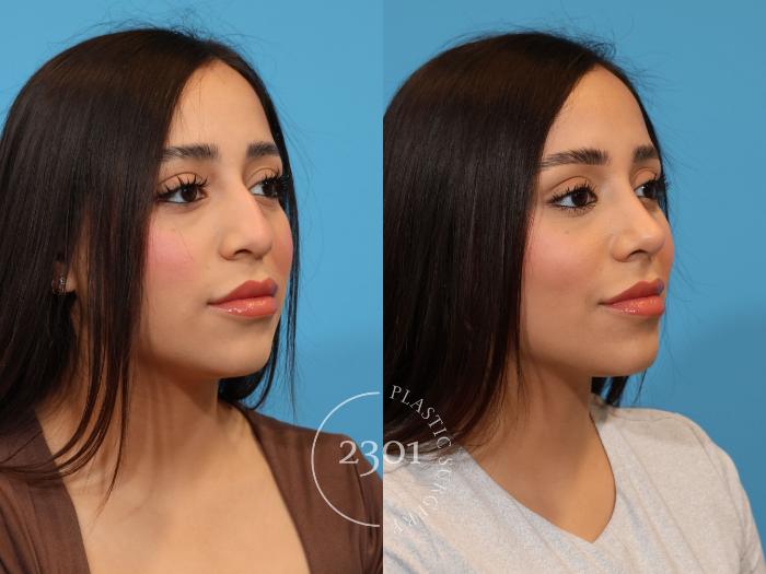 Before & After Rhinoplasty Case 922 Right Oblique View in Fort Worth, Plano, & Frisco, Texas