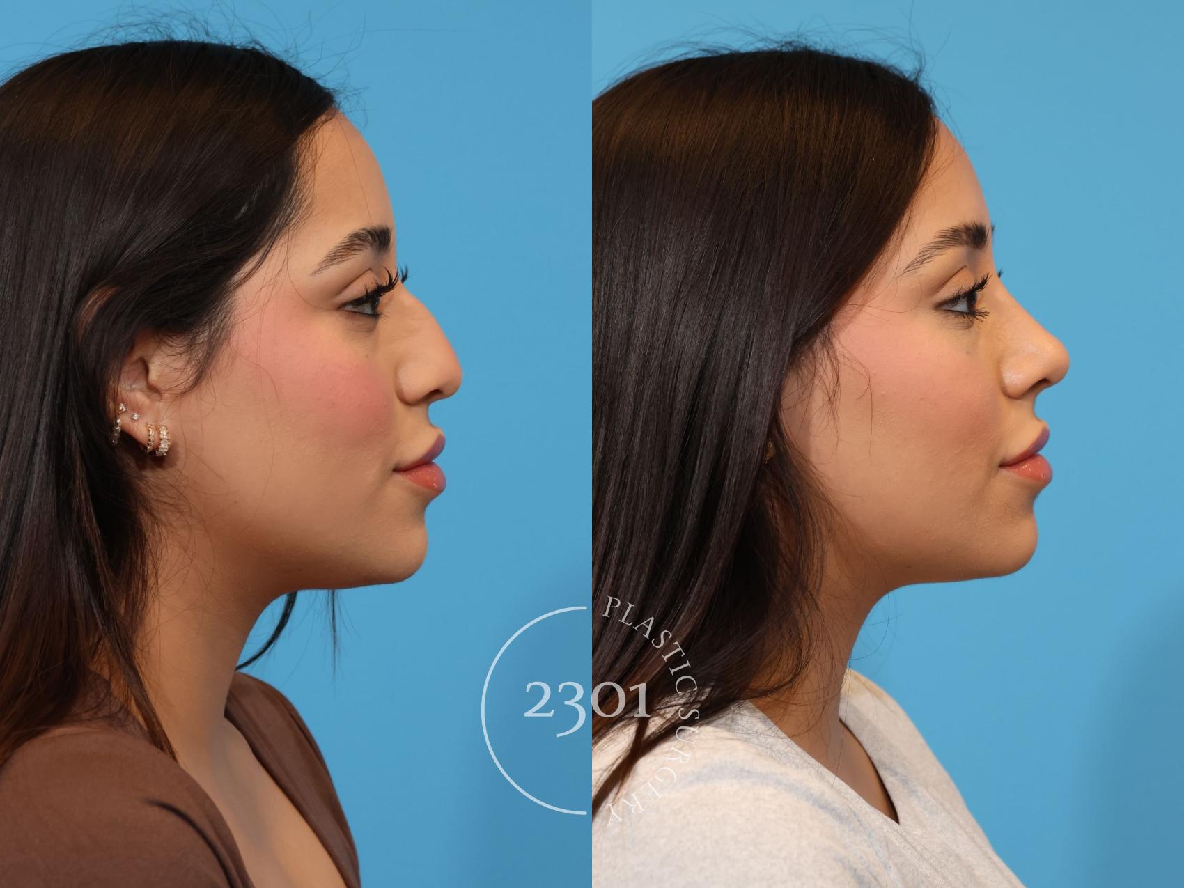 Before & After Rhinoplasty Case 922 Right Side View in Fort Worth, Plano, & Frisco, Texas