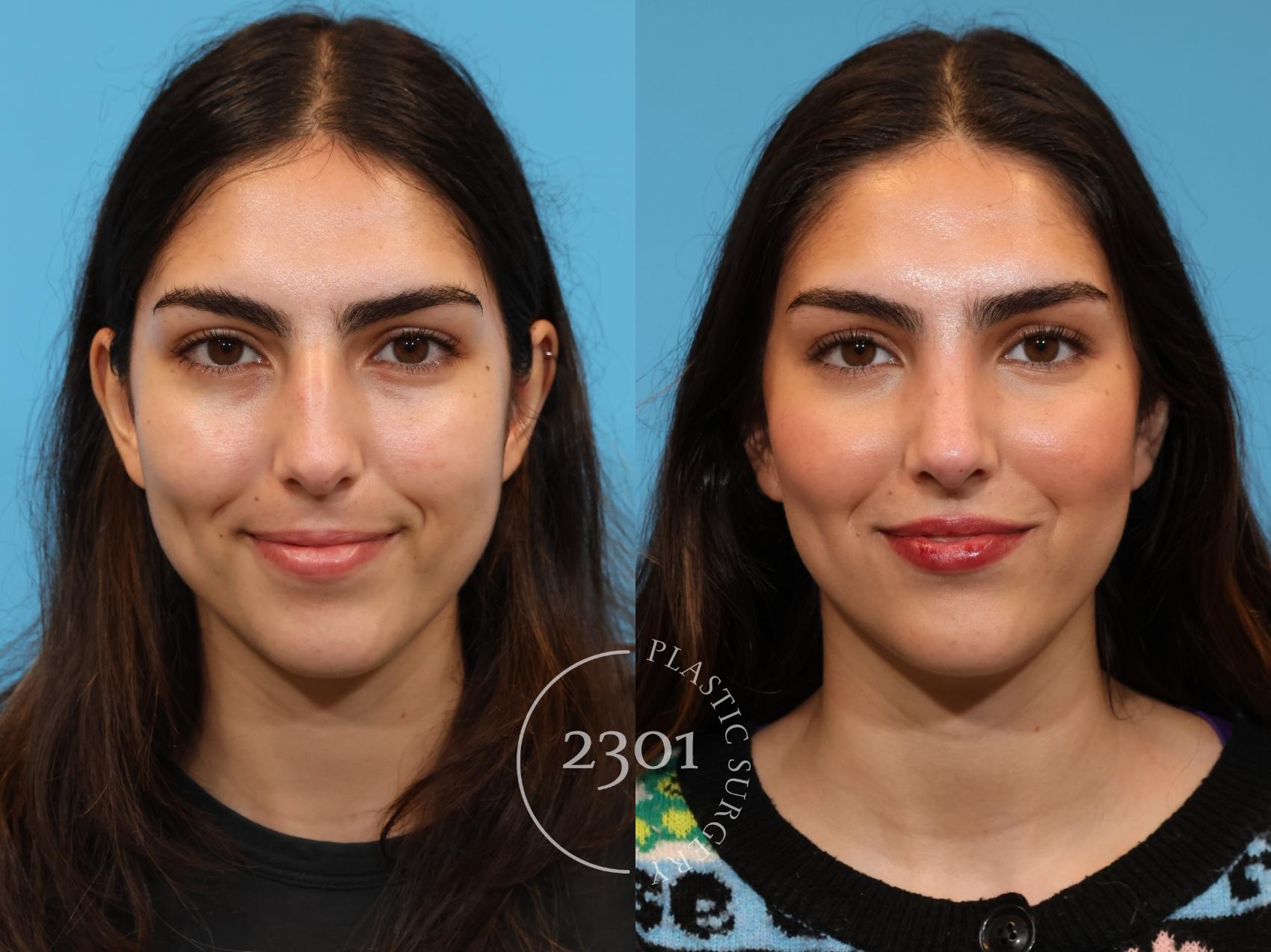 Before & After Rhinoplasty Case 924 Front View in Fort Worth, Plano, & Frisco, Texas