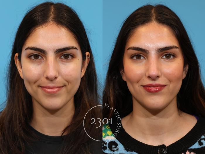 Before & After Rhinoplasty Case 924 Front View in Fort Worth, Plano, & Frisco, Texas