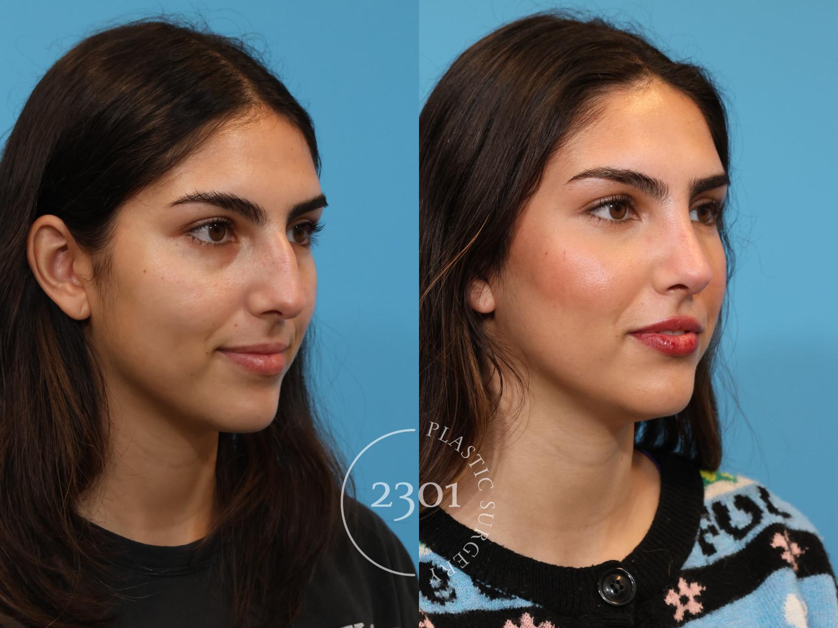 Before & After Rhinoplasty Case 924 Right Oblique View in Fort Worth, Plano, & Frisco, Texas