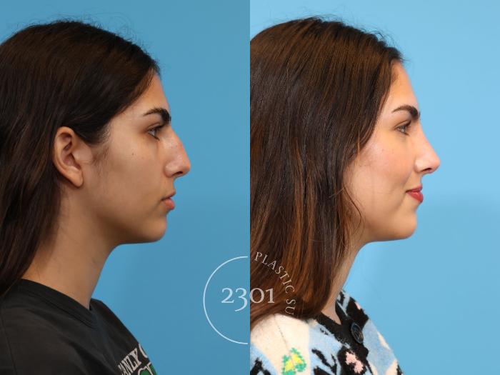 Before & After Rhinoplasty Case 924 Right Side View in Fort Worth, Plano, & Frisco, Texas