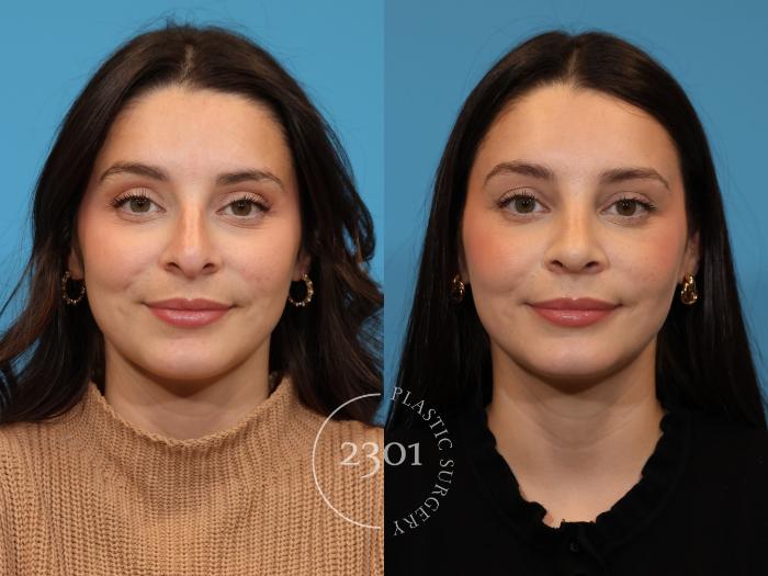 Before & After Rhinoplasty Case 925 Front View in Fort Worth, Plano, & Frisco, Texas