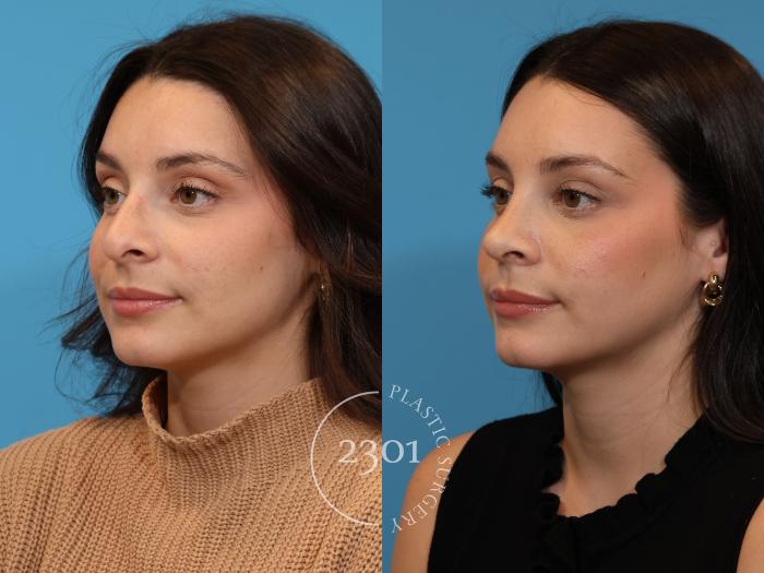 Before & After Rhinoplasty Case 925 Left Oblique View in Fort Worth, Plano, & Frisco, Texas