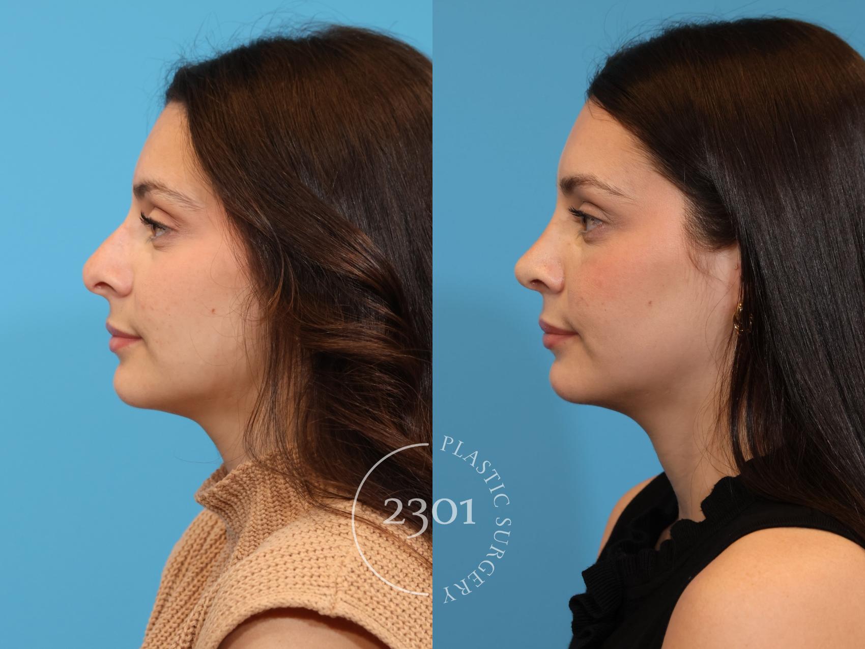 Before & After Rhinoplasty Case 925 Left Side View in Fort Worth, Plano, & Frisco, Texas