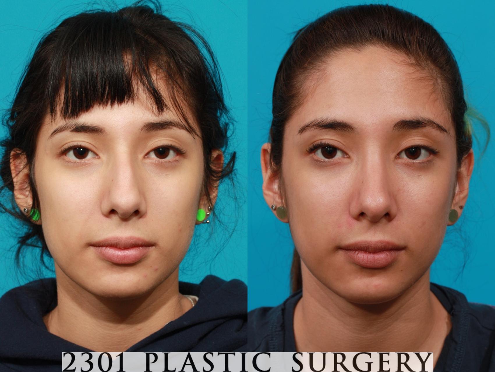 Before & After Rhinoplasty Case 93 View #1 View in Fort Worth & Frisco, Texas