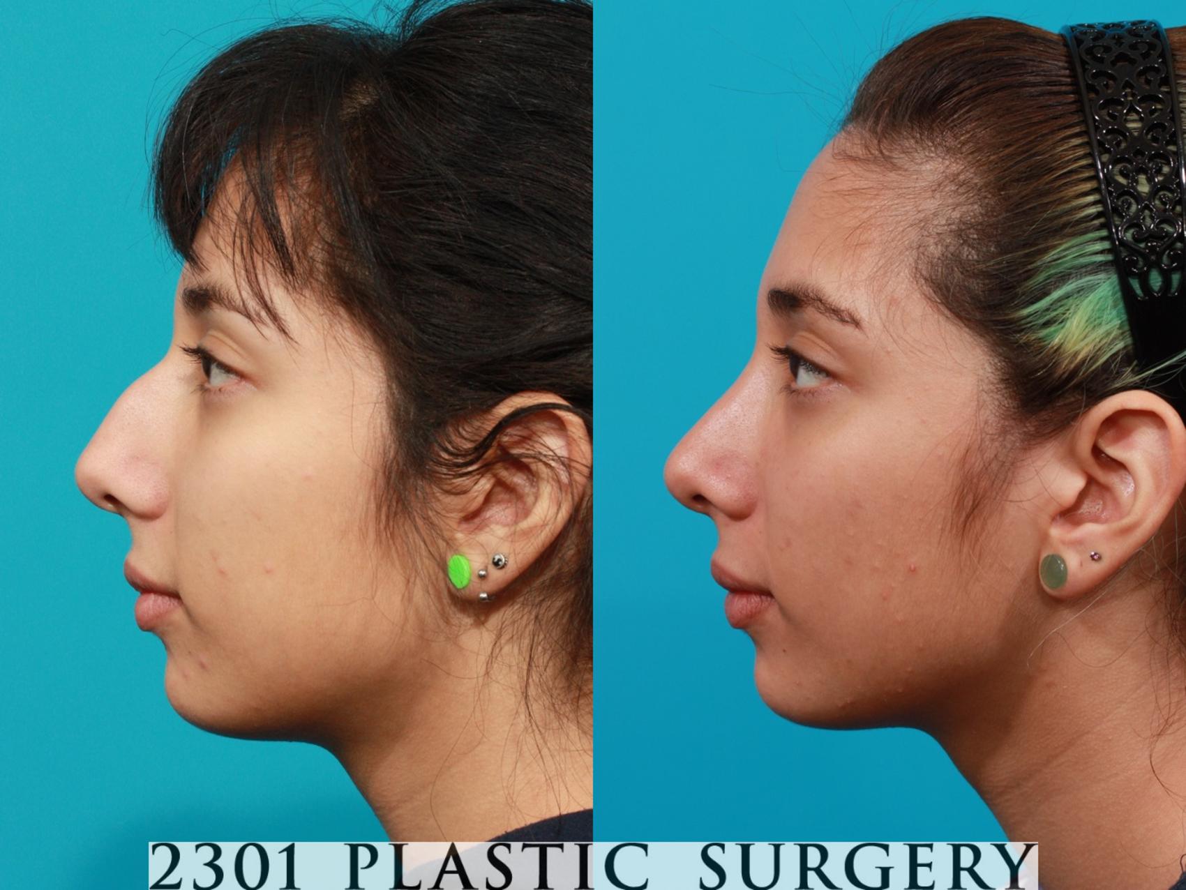 Before & After Rhinoplasty Case 93 View #2 View in Fort Worth, Plano, & Frisco, Texas