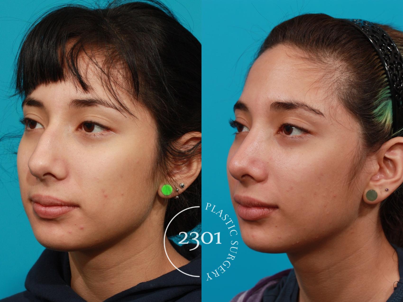 Before & After Rhinoplasty Case 93 View #3 View in Fort Worth, Plano, & Frisco, Texas