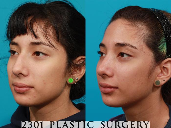 Before & After Rhinoplasty Case 93 View #3 View in Fort Worth, Plano, & Frisco, Texas